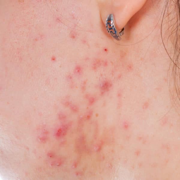 Can Wearing Sunscreen Make Acne Worse Short Hills Dermatology can-wearing-sunscreen-make-acne-worse-short-hills-dermatology