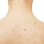 back-acne