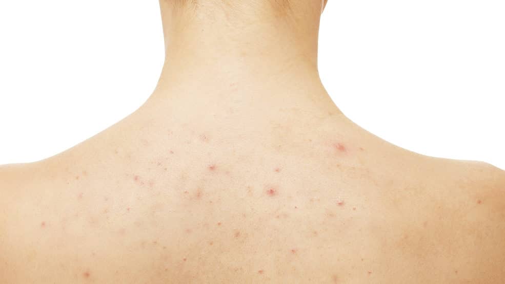 What You Need to Know About Back Acne