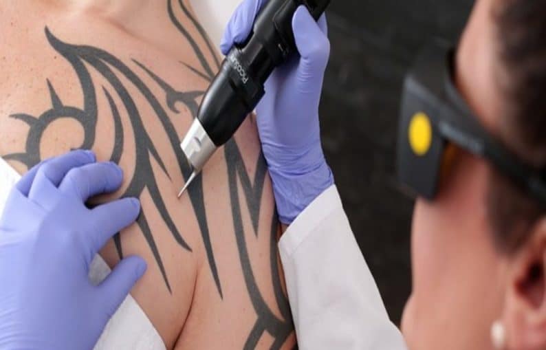 All You Need To Know About Laser Tattoo Removal | Short Hills Dermatology