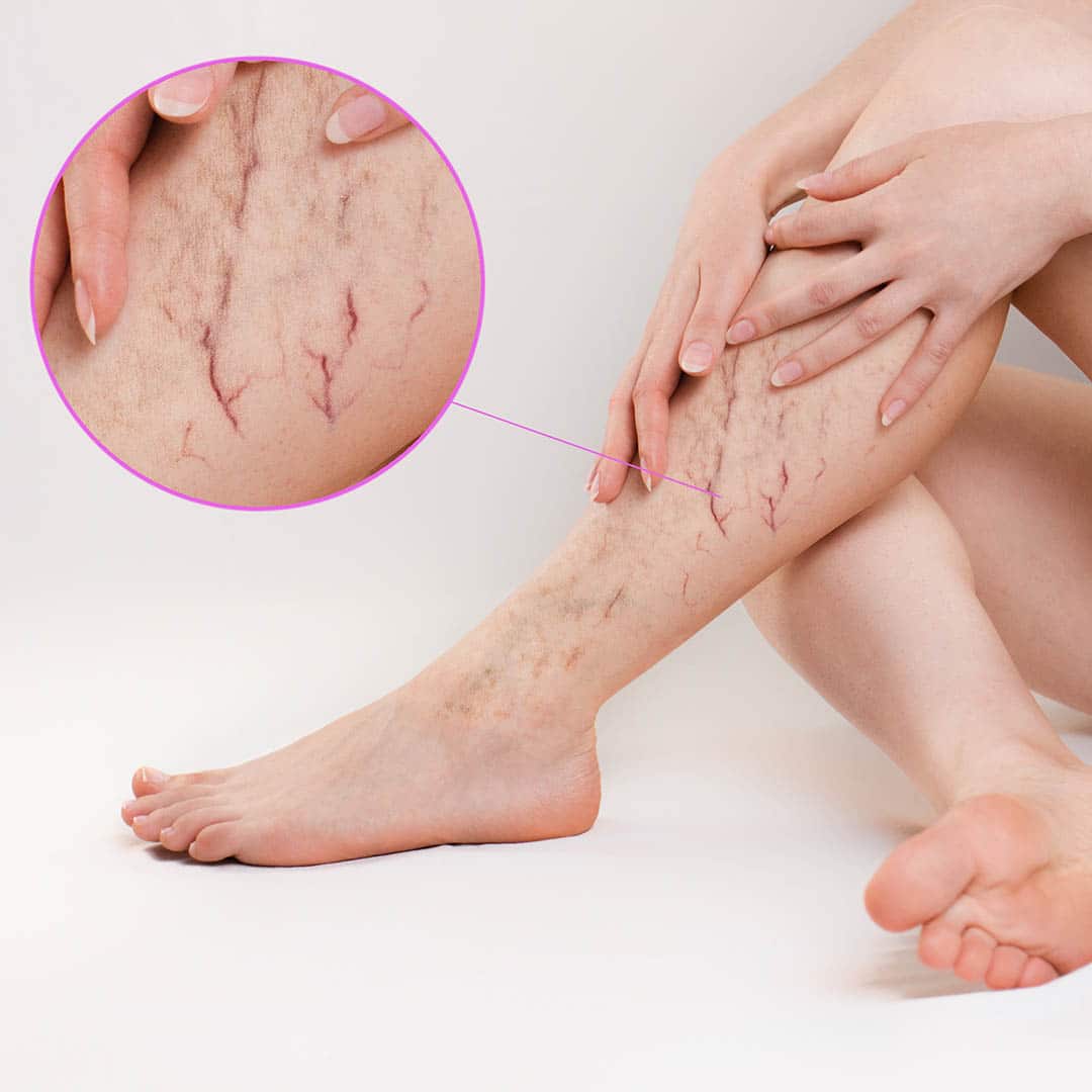 Treatment of spider veins with Dermatology Consultants of Short Hills!