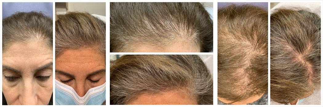 Before and after collage showing older woman's scalp highlighting hair regrowth