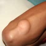 Lipoma on the elbow of the arm.