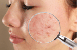 Treating acne with the help of a dermatologist in Short Hills, NJ