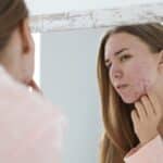 woman with acne problem near mirror in bathroom