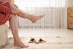 Natural Remedies for Varicose Veins