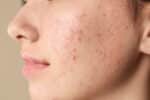 How Does Adult Acne Differ From Teenage Acne?