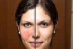 Can Menopause Cause Rosacea?