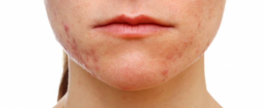 Acne Treatments for Teenagers Acne Treatments for Teenagers