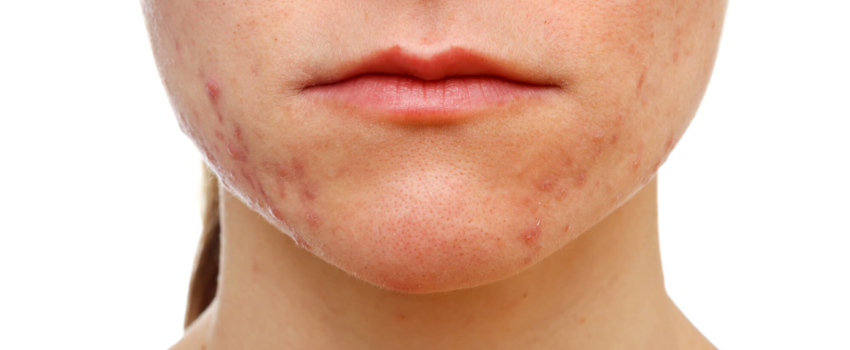 Acne Treatments for Adults