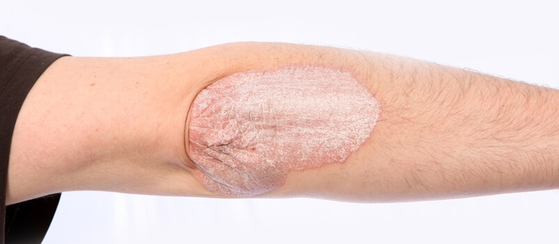 Services_Eczema Services_Eczema