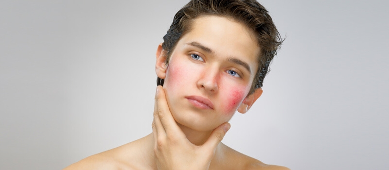 Services_Rosacea Rosacea
