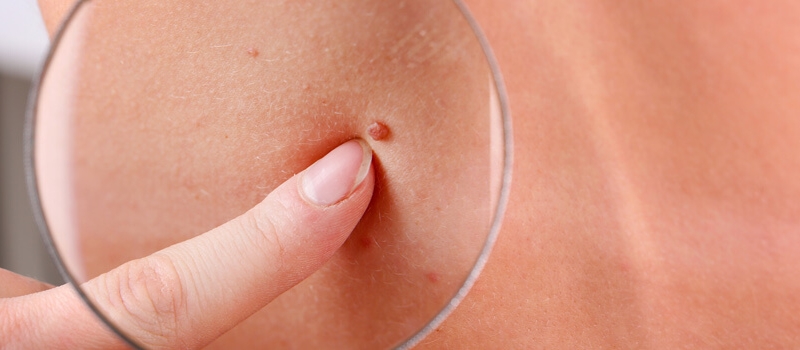 Services_SkinCancerFacts Services_SkinCancerFacts