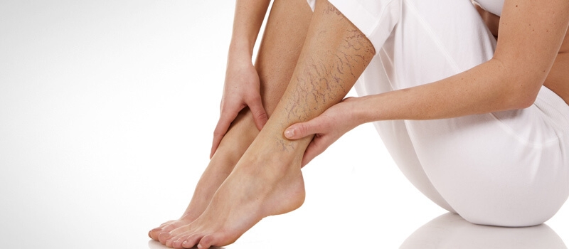 Services_VaricoseVeins Services_VaricoseVeins