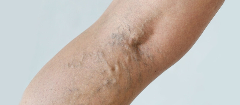 Services_spiderveins Services_spiderveins