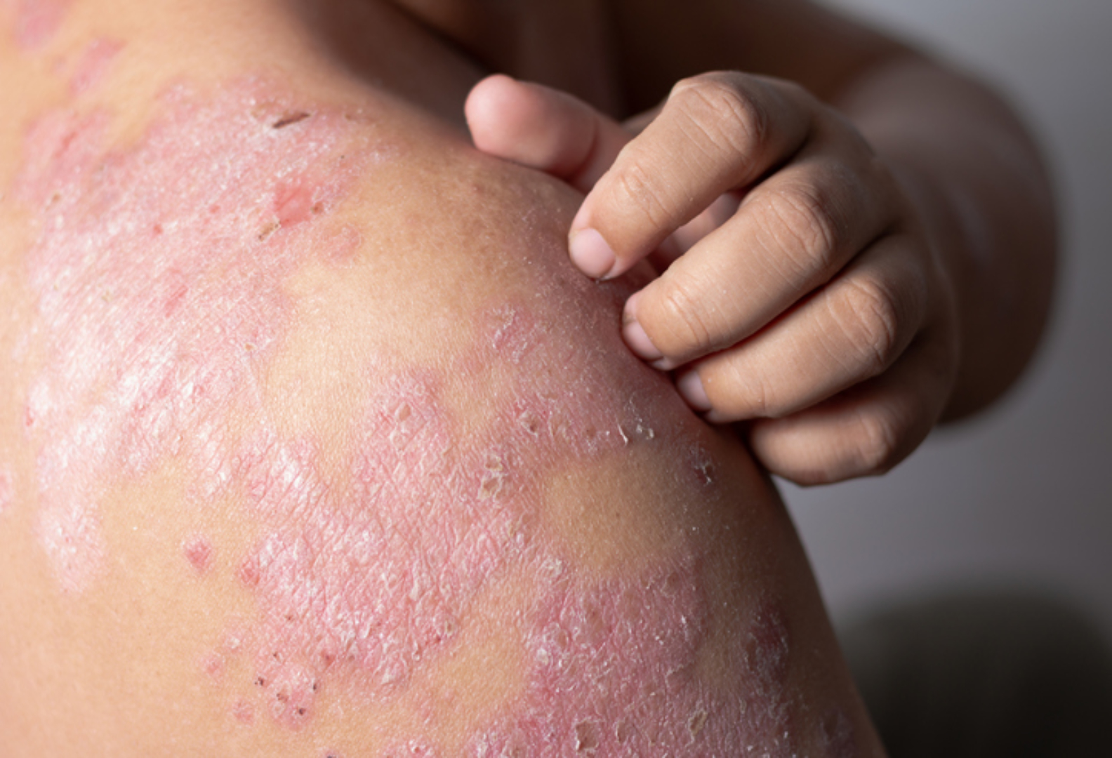 Treatment Options for Eczema | Short Hills Dermatology