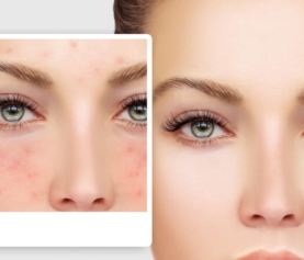 How to Treat Rosacea