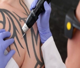 All You Need To Know About Laser Tattoo Removal