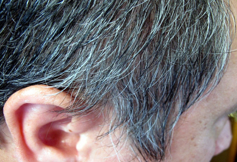 the-patient-s-hair-notable-for-diffuse-premature-graying-of-hair