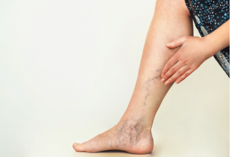 What Are Varicose Veins?