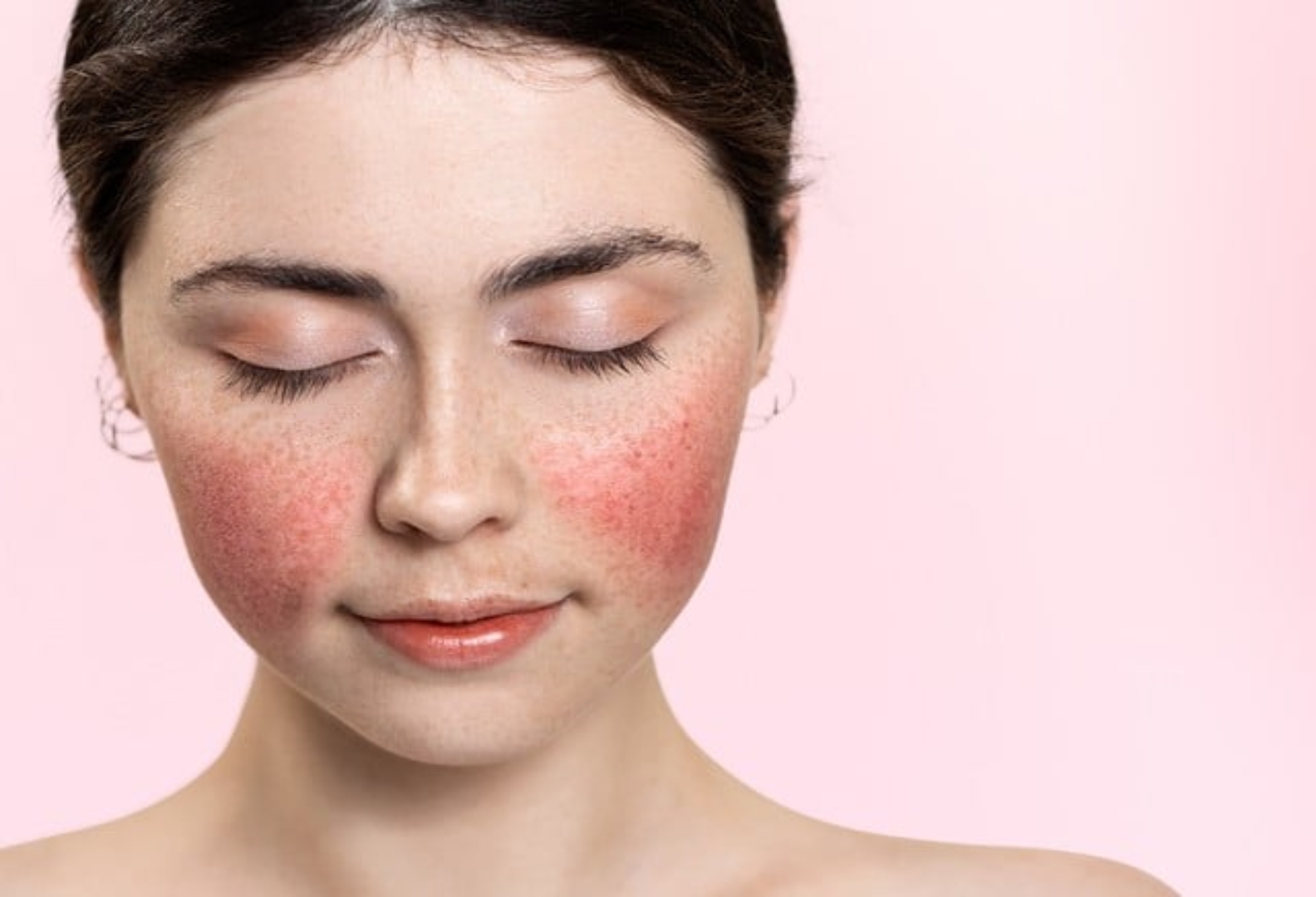 How can I manage my rosacea? Short Hills Dermatology